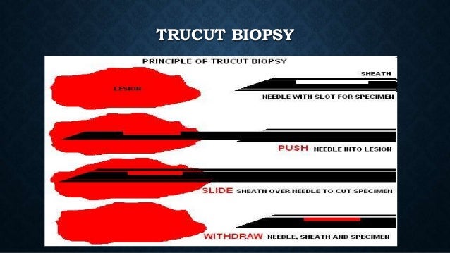 tru cut biopsy breast Girls getting tied to have sex